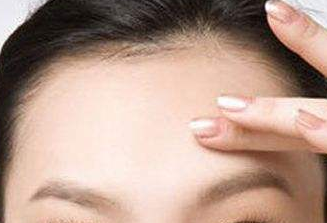 自體脂肪豐額頭效果能保持多久