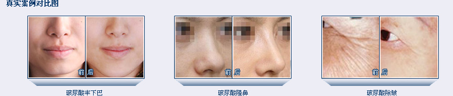 美萊玻尿酸效果對比圖