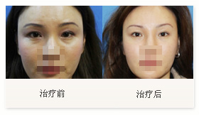 治療黑眼圈案例一