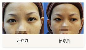 治療黑眼圈案例一