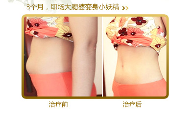 美萊中醫(yī)健康減肥案例-大腹婆變身小妖精