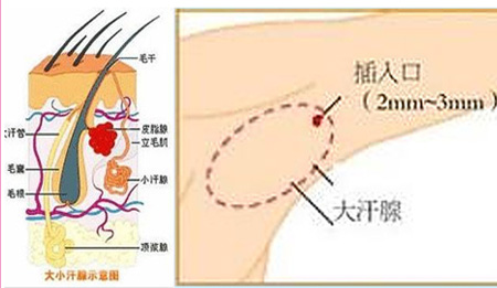 美國(guó)BOTOX祛腋臭