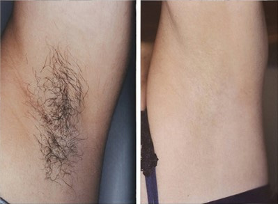 miraDry微波腋汗術(shù)臨床真實(shí)案例圖1