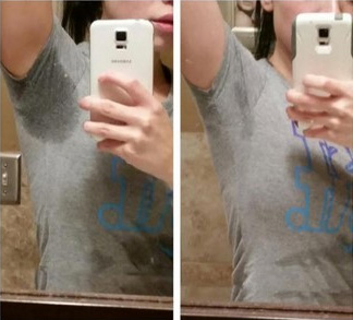 miraDry微波腋汗術(shù)臨床真實(shí)案例圖2