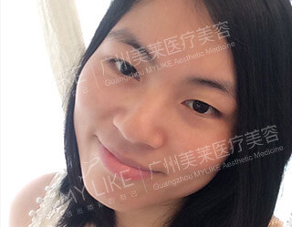 術(shù)前 ― 正面