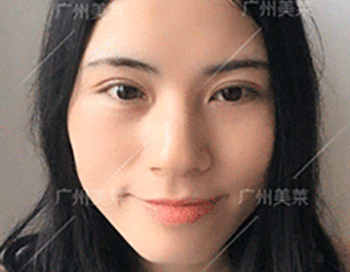 術(shù)前 ― 45°