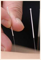 針灸埋線減肥_身體美容項(xiàng)目